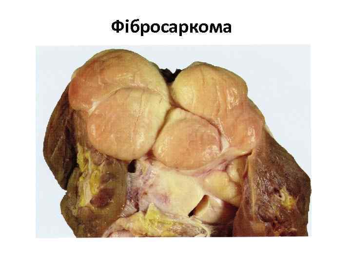 Фібросаркома 