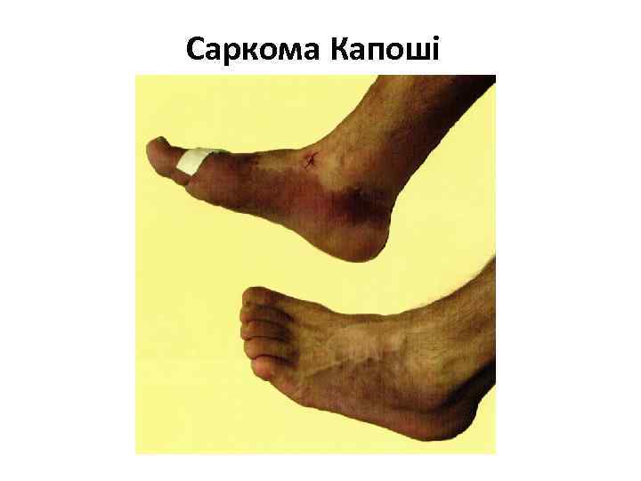 Саркома Капоші 