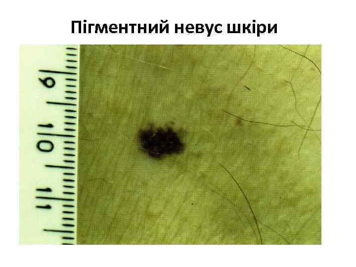 Пігментний невус шкіри 