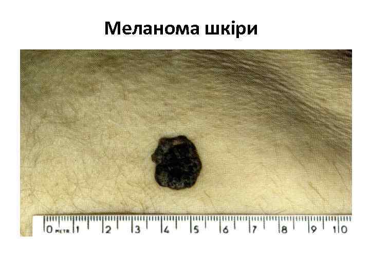 Меланома шкіри 