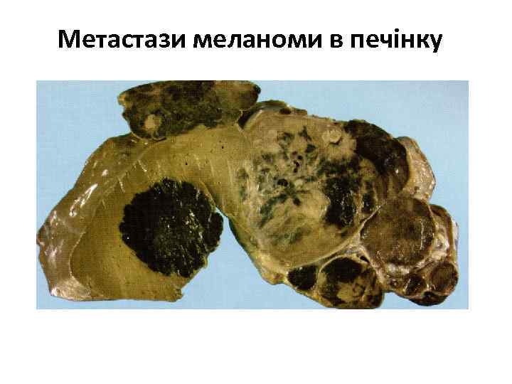 Метастази меланоми в печінку 