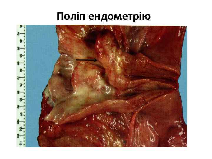 Поліп ендометрію 