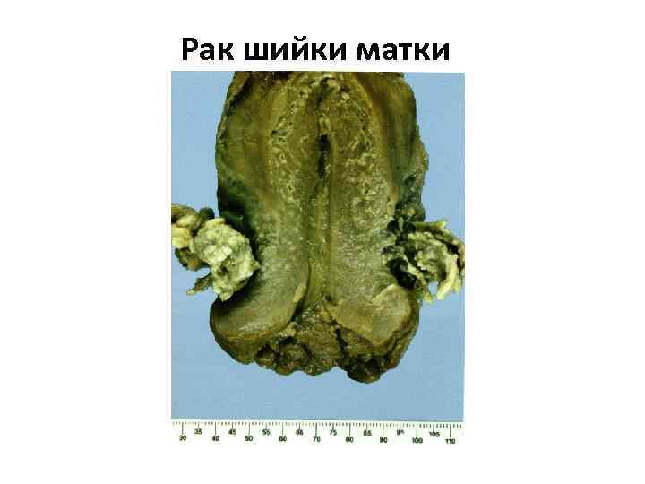 Рак шийки матки 