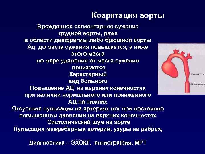 Коарктация аорты Врожденное сегментарное сужение грудной аорты, реже в области диафрагмы либо брюшной аорты