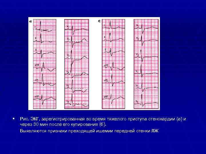 § Рис. ЭКГ, зарегистрированная во время тяжелого приступа стенокардии (а) и через 30 мин