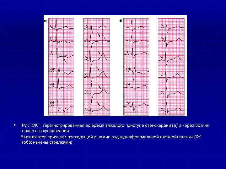 Ишемия нижней стенки на экг