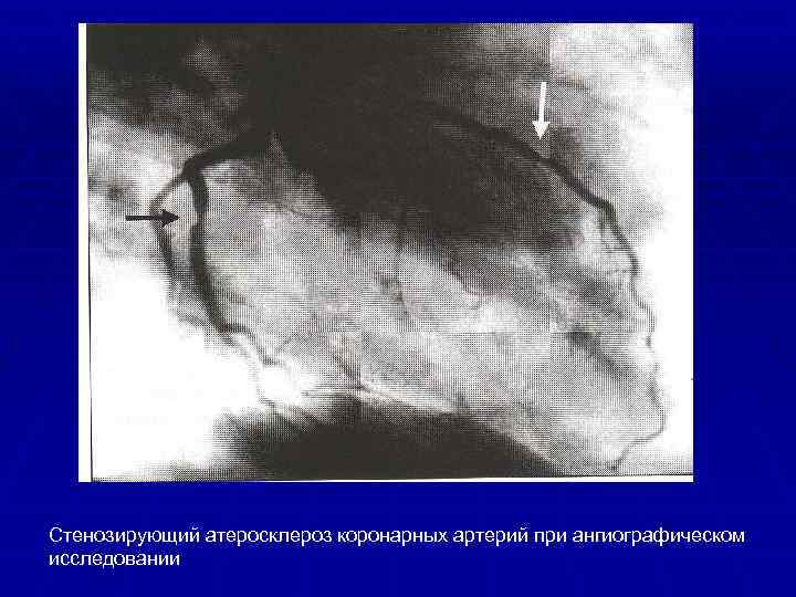 Уз признаки атеросклероза бца. Стенозирующий атеросклероз коронарных артерий. Стенозирующий атеросклероз венечной артерии. Стенозирующий атеросклероз и нестенозирующий отличия. Стенозирующем атеросклерозе коронарных это.