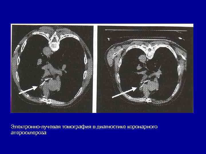 Электронно лучевая томография в диагностике коронарного атеросклероза 