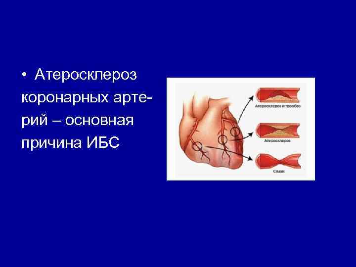  • Атеросклероз коронарных арте рий – основная причина ИБС 