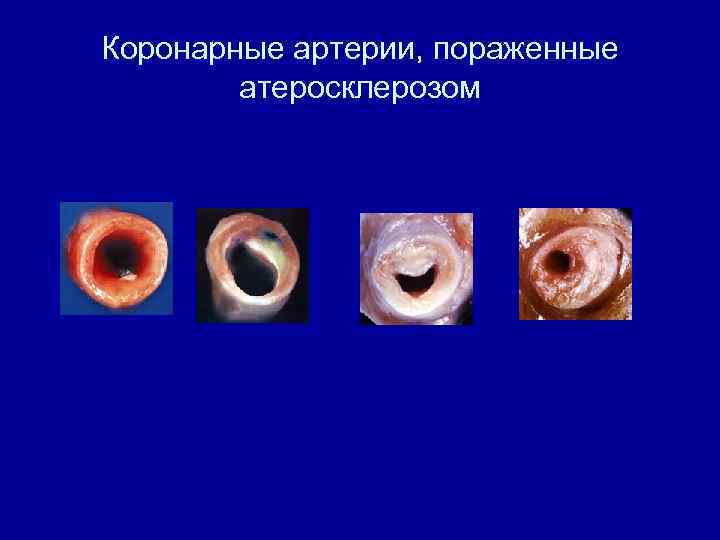 Коронарные артерии, пораженные атеросклерозом 