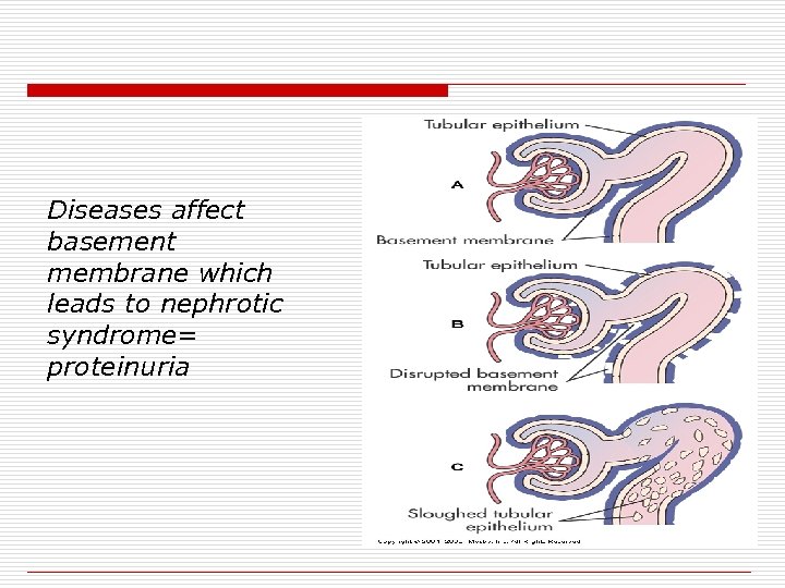 Diseases affect basement membrane which leads to nephrotic syndrome= proteinuria 