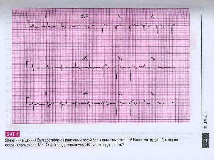 Ишемия нижней стенки на экг что это