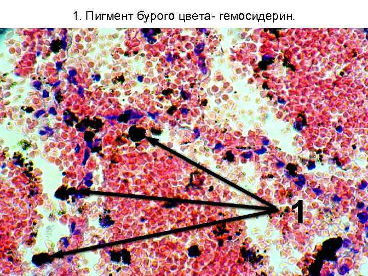 1. Пигмент бурого цвета- гемосидерин. 