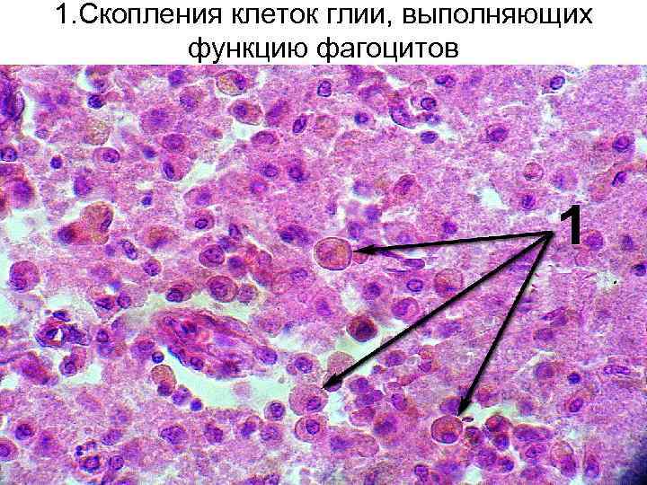 1. Скопления клеток глии, выполняющих функцию фагоцитов 