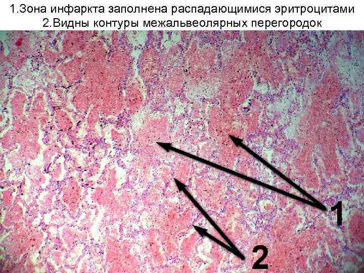 Ишемический инфаркт головного мозга. Инфаркт мозга микропрепарат. Ишемический инфаркт головного мозга патанатомия. Инфаркт головного мозга микропрепарат. Ишемический инфаркт мозга микропрепарат.