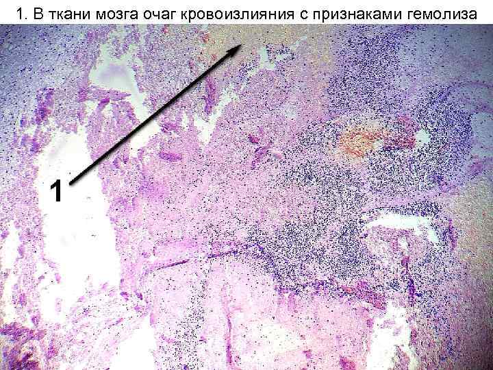 1. В ткани мозга очаг кровоизлияния с признаками гемолиза 