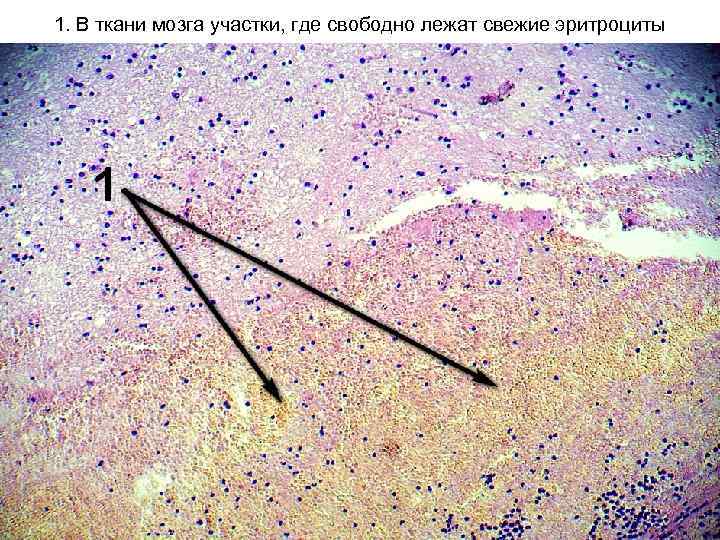 1. В ткани мозга участки, где свободно лежат свежие эритроциты 