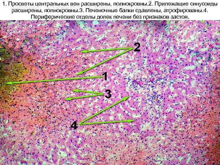 1. Просветы центральных вен расширены, полнокровны. 2. Прилежащие синусоиды расширены, полнокровны. 3. Печеночные балки