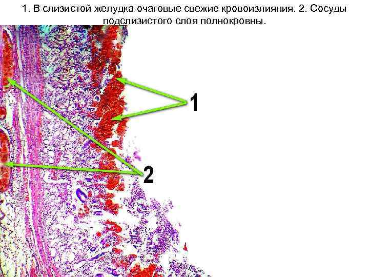 1. В слизистой желудка очаговые свежие кровоизлияния. 2. Сосуды подслизистого слоя полнокровны. 