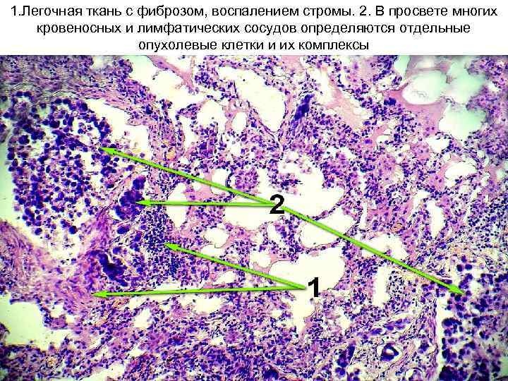 1. Легочная ткань с фиброзом, воспалением стромы. 2. В просвете многих кровеносных и лимфатических