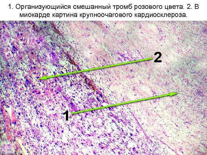 1. Организующийся смешанный тромб розового цвета. 2. В миокарде картина крупноочагового кардиосклероза. 