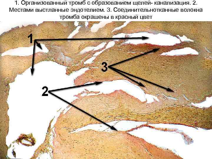 1. Организованный тромб с образованием щелей- канализация. 2. Местами выстланные эндотелием. 3. Соединительнотканные волокна