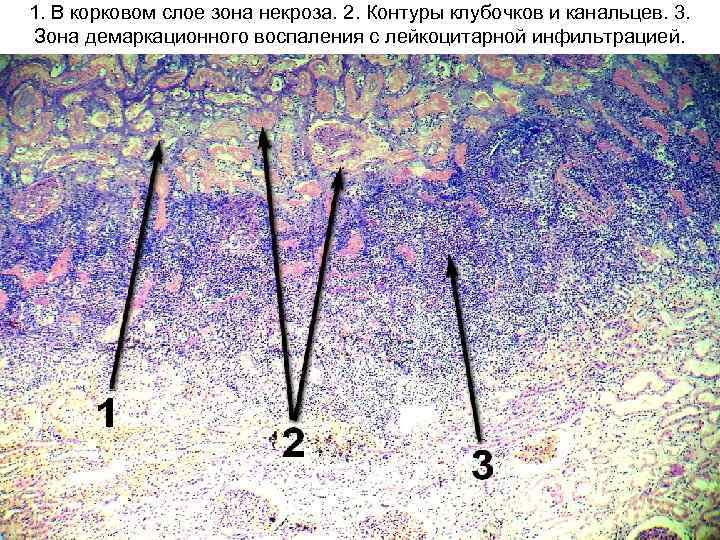 1. В корковом слое зона некроза. 2. Контуры клубочков и канальцев. 3. Зона демаркационного
