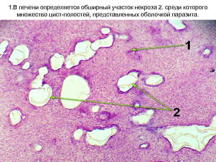 1. В печени определяется обширный участок некроза 2. среди которого множество цист-полостей, представленных оболочкой