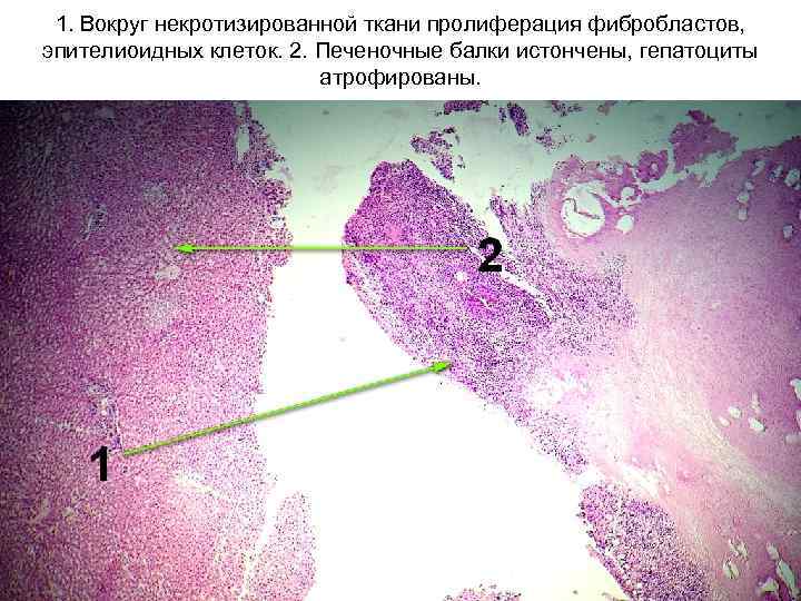 1. Вокруг некротизированной ткани пролиферация фибробластов, эпителиоидных клеток. 2. Печеночные балки истончены, гепатоциты атрофированы.