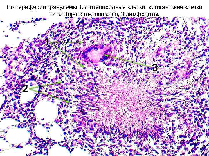 По периферии гранулемы 1. эпителиоидные клетки, 2. гигантские клетки типа Пирогова-Лангганса, 3. лимфоциты. 