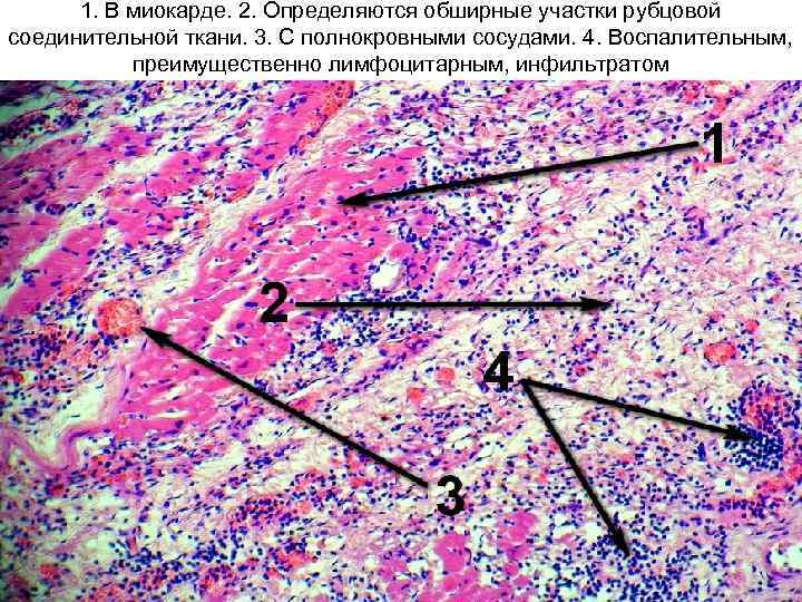 1. В миокарде. 2. Определяются обширные участки рубцовой соединительной ткани. 3. С полнокровными сосудами.