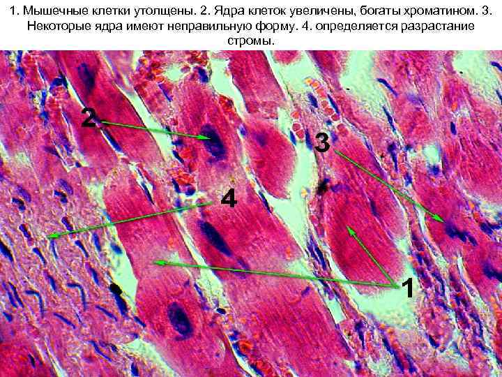 1. Мышечные клетки утолщены. 2. Ядра клеток увеличены, богаты хроматином. 3. Некоторые ядра имеют