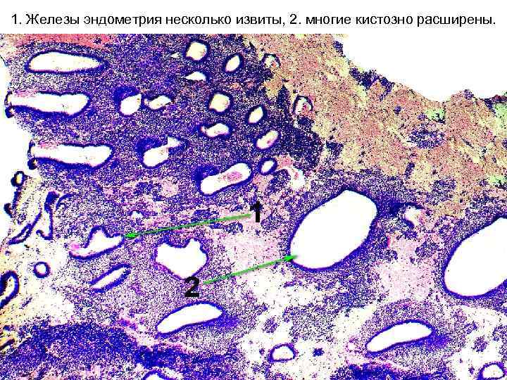 1. Железы эндометрия несколько извиты, 2. многие кистозно расширены. 