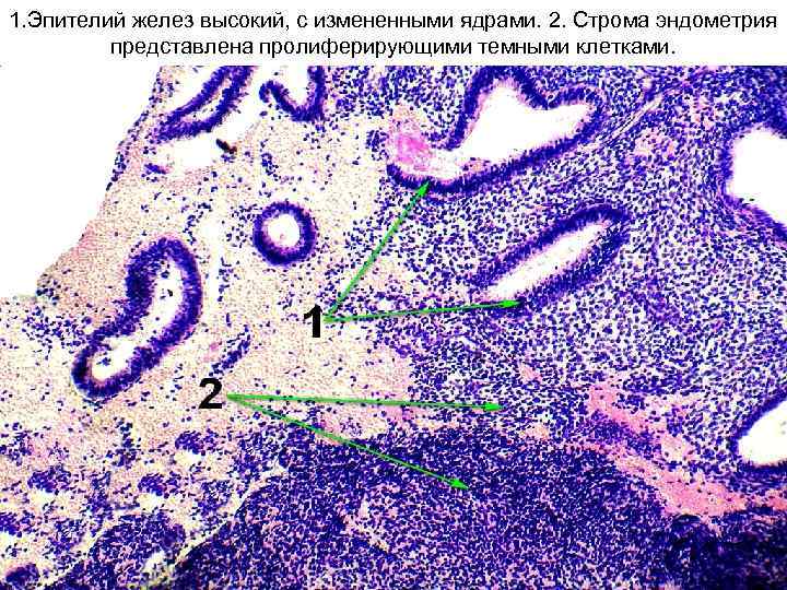 1. Эпителий желез высокий, с измененными ядрами. 2. Строма эндометрия представлена пролиферирующими темными клетками.