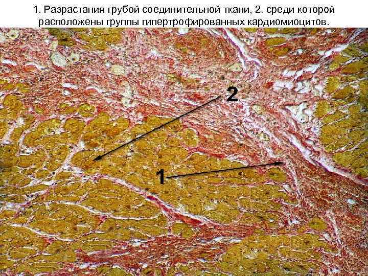 1. Разрастания грубой соединительной ткани, 2. среди которой расположены группы гипертрофированных кардиомиоцитов. 