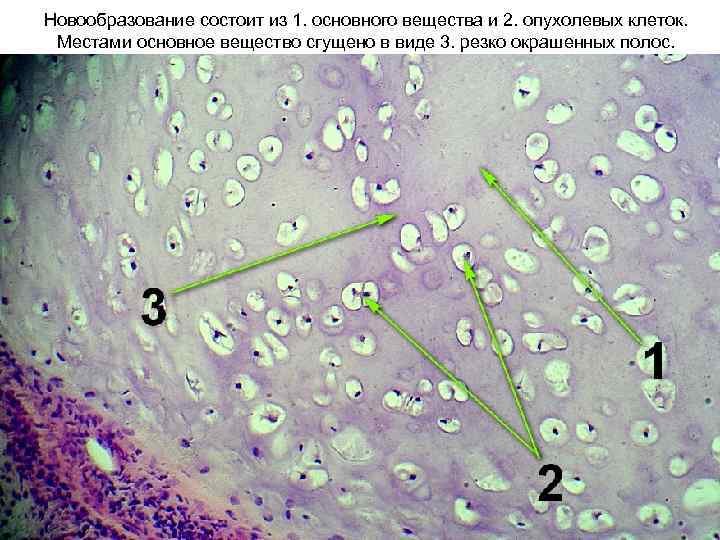 Новообразование состоит из 1. основного вещества и 2. опухолевых клеток. Местами основное вещество сгущено