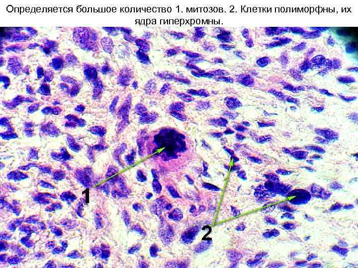 Определяется большое количество 1. митозов. 2. Клетки полиморфны, их ядра гиперхромны. 