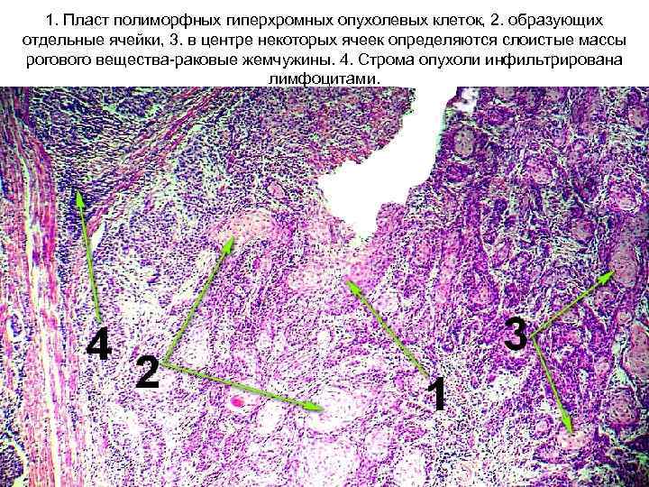 1. Пласт полиморфных гиперхромных опухолевых клеток, 2. образующих отдельные ячейки, 3. в центре некоторых