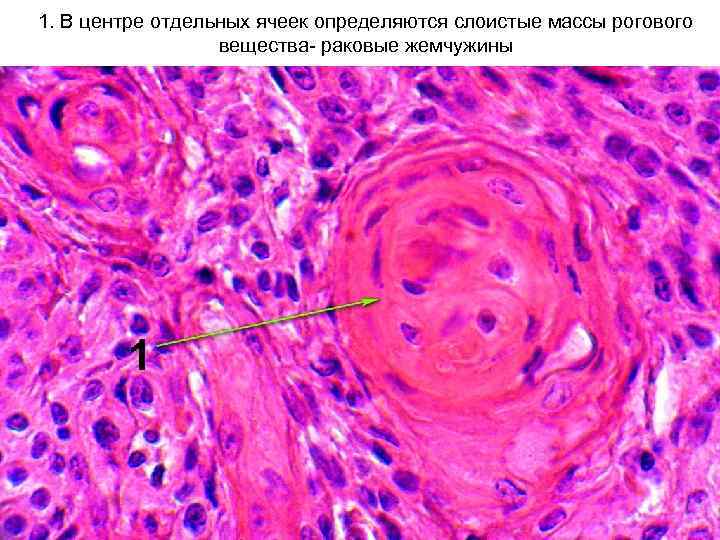 1. В центре отдельных ячеек определяются слоистые массы рогового вещества- раковые жемчужины 