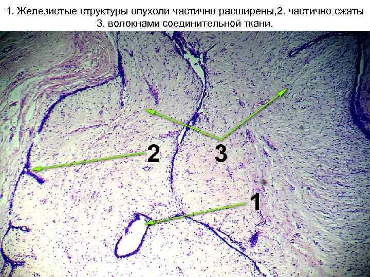 1. Железистые структуры опухоли частично расширены, 2. частично сжаты 3. волокнами соединительной ткани. 