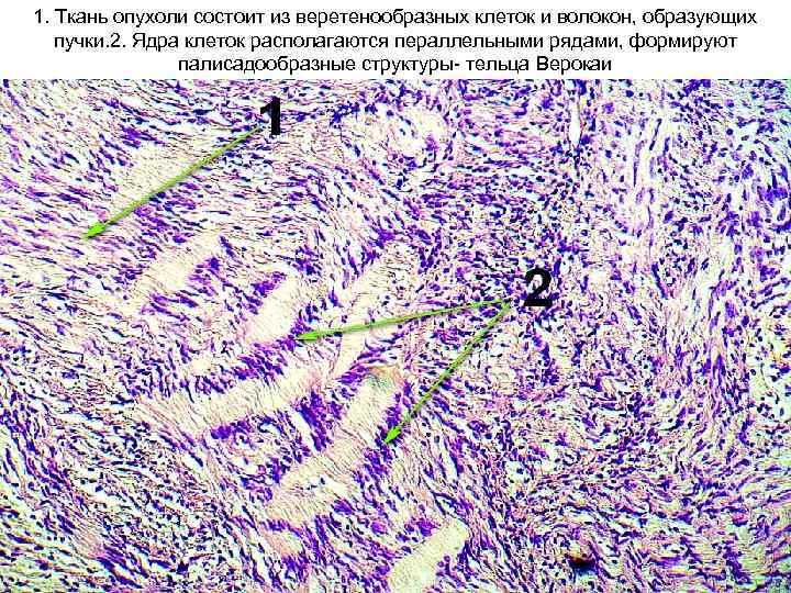 1. Ткань опухоли состоит из веретенообразных клеток и волокон, образующих пучки. 2. Ядра клеток