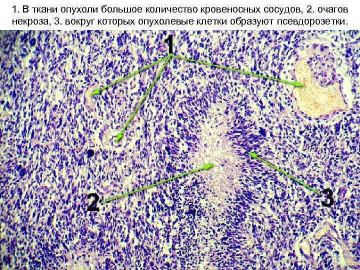 1. В ткани опухоли большое количество кровеносных сосудов, 2. очагов некроза, 3. вокруг которых