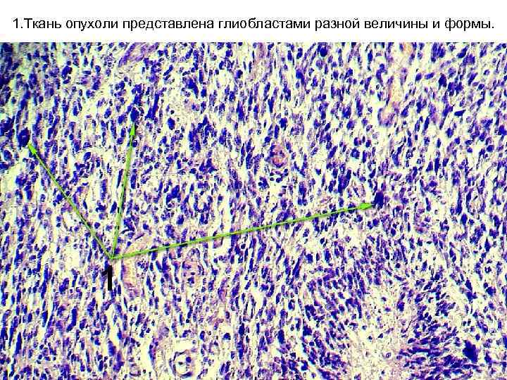 1. Ткань опухоли представлена глиобластами разной величины и формы. 