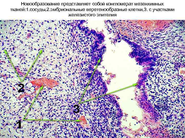 Новообразование представляет собой конгломерат мезенхимных тканей: 1. сосуды, 2. эмбриональные веретенообразные клетки, 3. с