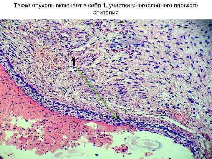 Также опухоль включает в себя 1. участки многослойного плоского эпителия 