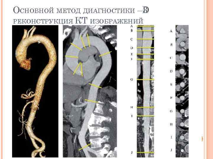 ОСНОВНОЙ МЕТОД ДИАГНОСТИКИ – 3 D РЕКОНСТРУКЦИЯ КТ ИЗОБРАЖЕНИЙ 