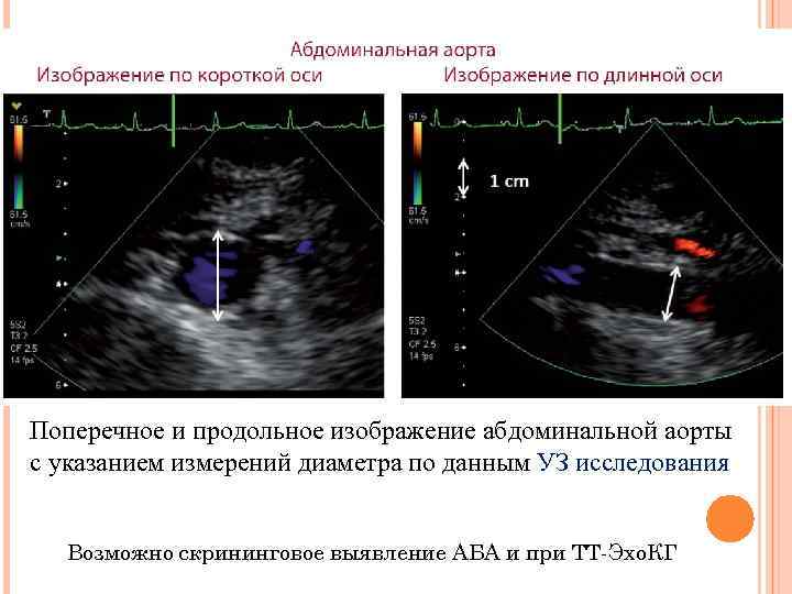 Поперечное и продольное изображение абдоминальной аорты с указанием измерений диаметра по данным УЗ исследования