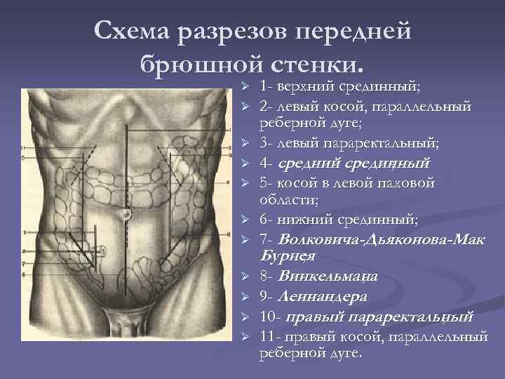 Схема разрезов передней брюшной стенки. Ø Ø Ø 1 - верхний срединный; 2 -