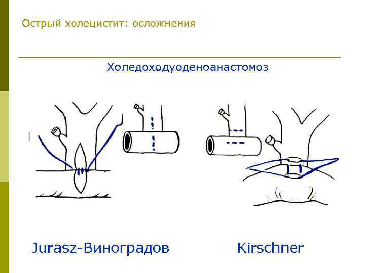 Острый холецистит: осложнения Холедоходуоденоанастомоз Jurasz-Виноградов Kirschner 