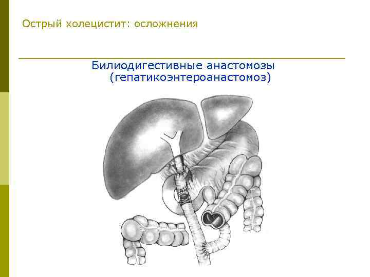 Холецистит карта смп